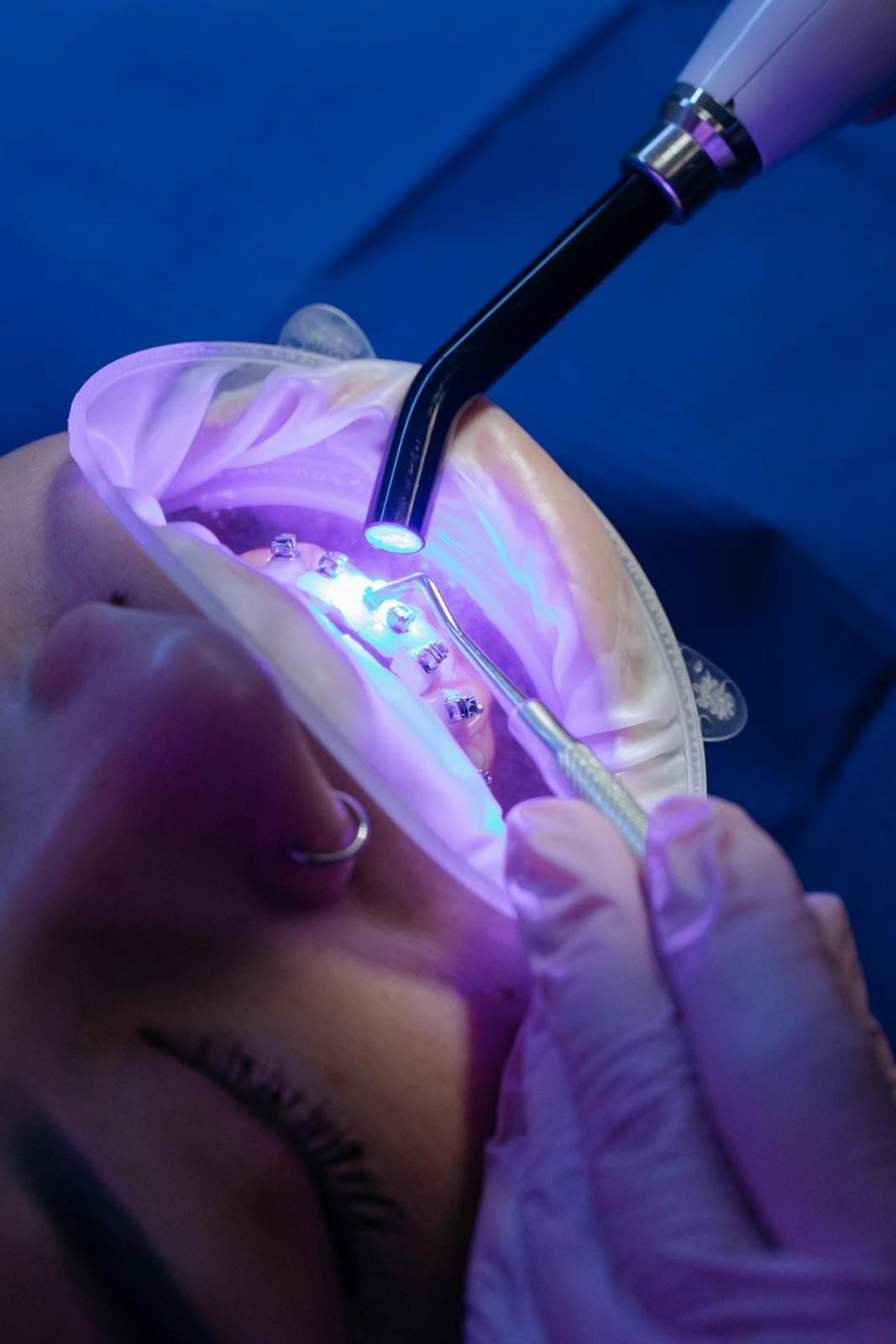 laser-dental-treatment-in-karuppayurani-madurai